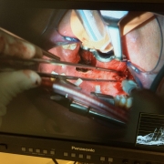 surgical procedures